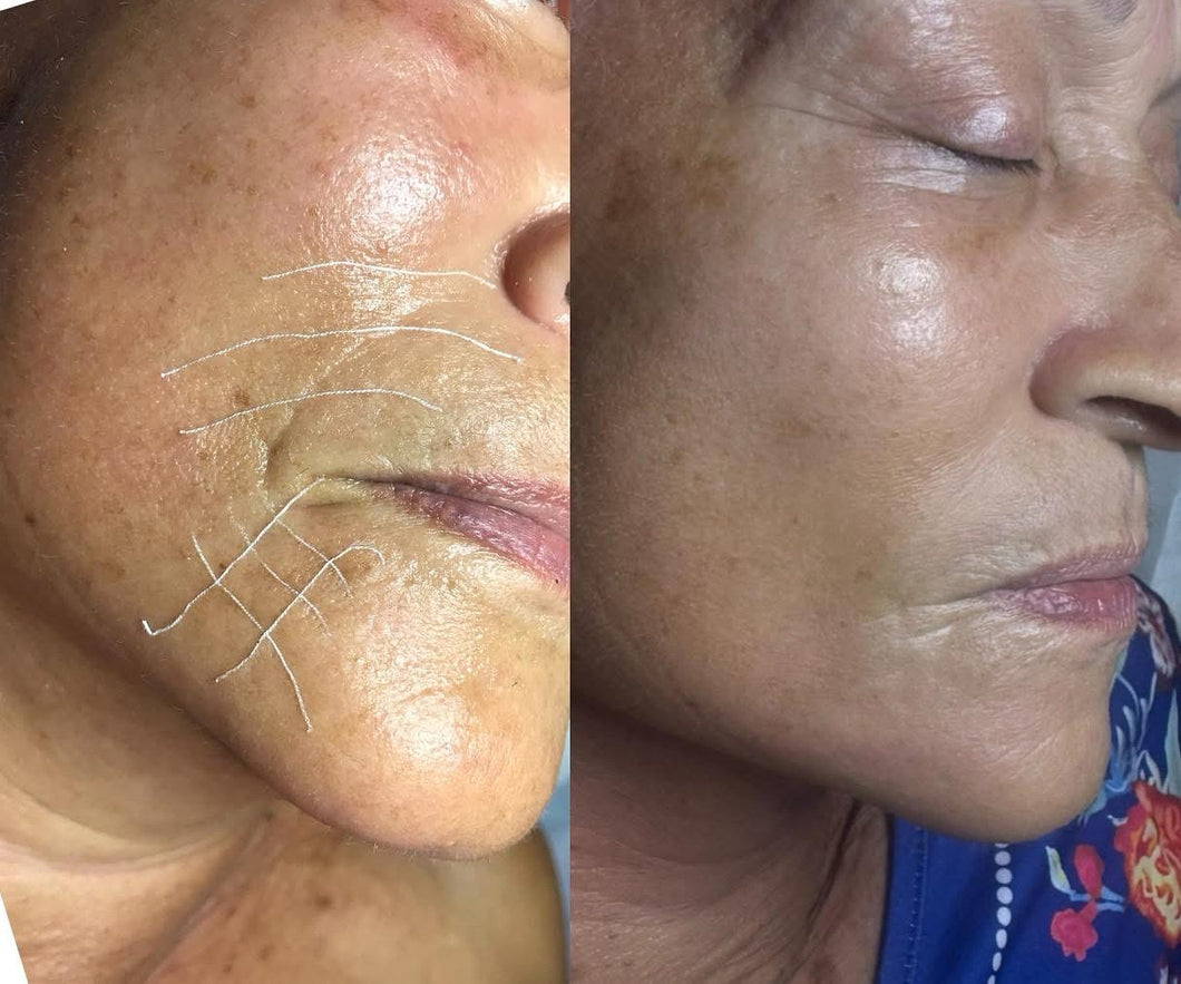 Servicio Facial Detox Age + Hilos Absorbibles dé  Colagéno y Seda