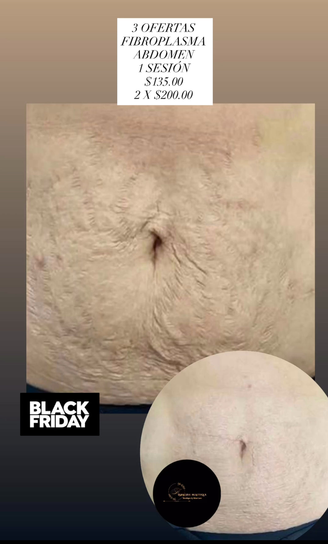 ¡FIBROPLASMA ABDOMEN! 2 SESIÓNES
