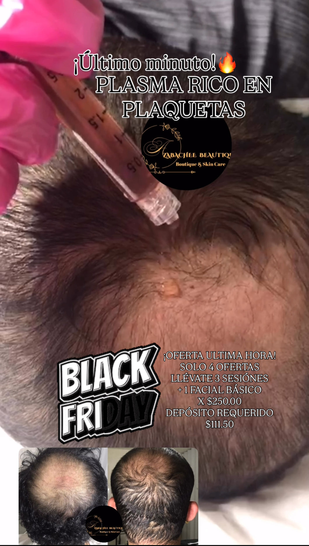 ¡OFERTA ULTIMO MINUTO!🔥PLASMA RICO EN PLAQUETAS