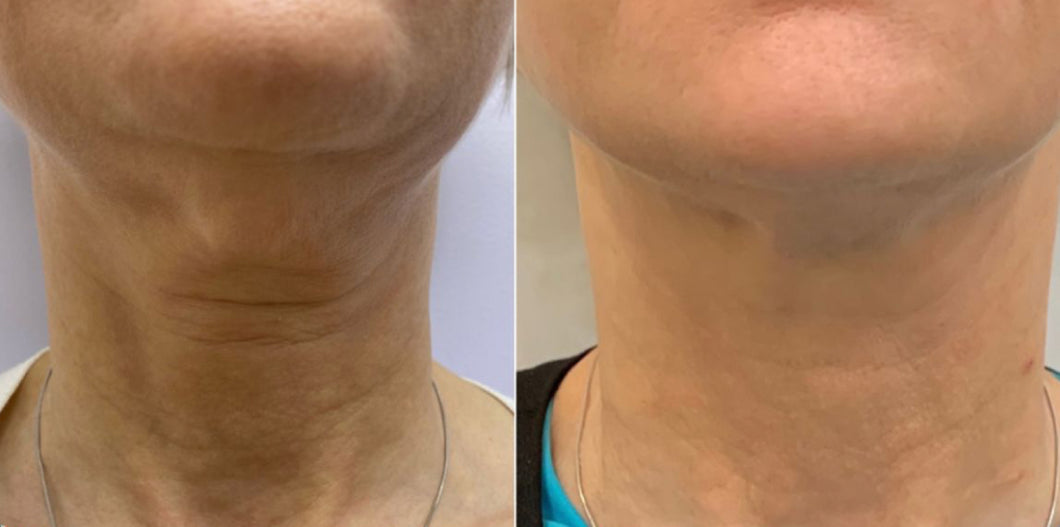 OFERTA FIBROPLASMA CUELLO + CREMA POST TRATAMIENTO