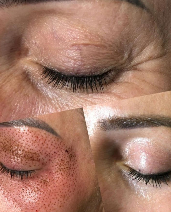 OFERTA FIBROPLASMA PÁRPADO SUPERIOR O INFERIOR