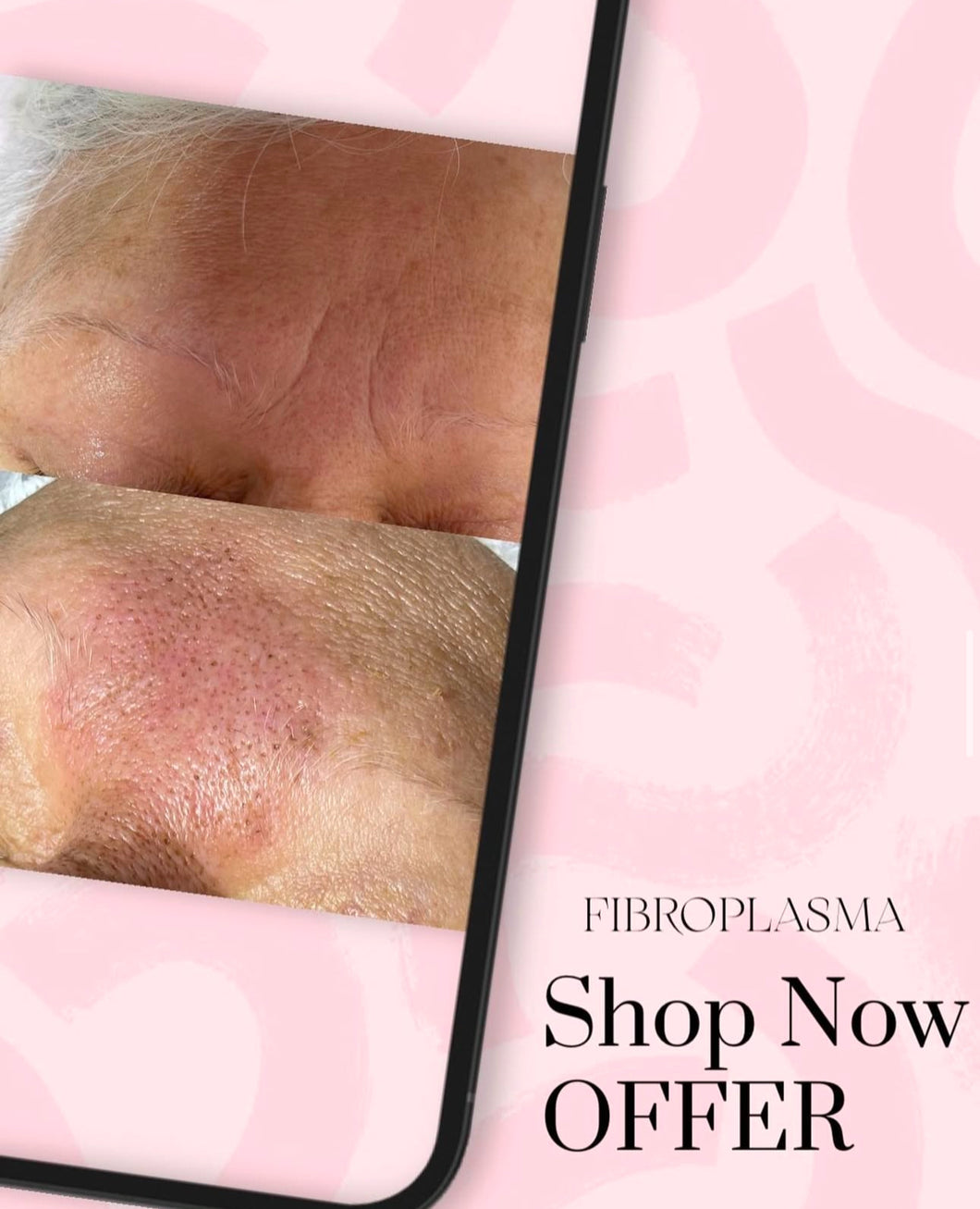 FIBROPLASMA ENTRECEJO $75.00
