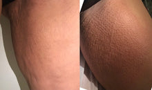 Cargar imagen en el visor de la galería, Rejuvenecimiento FIBROPLASMA DERMOTEC MUSLO INTERNO
