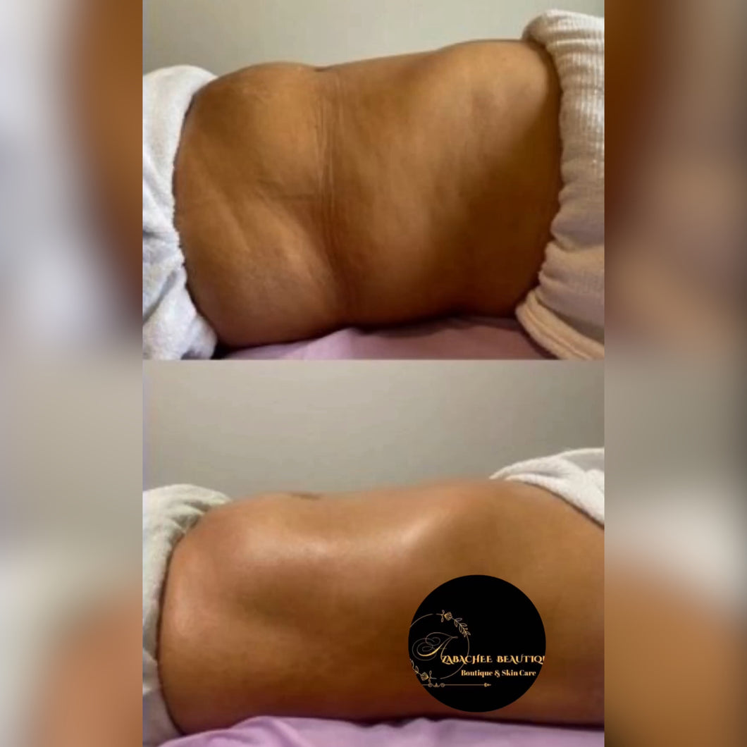 4 SESIÓNES DE LIPOLASER REDUCE ABDOMEN